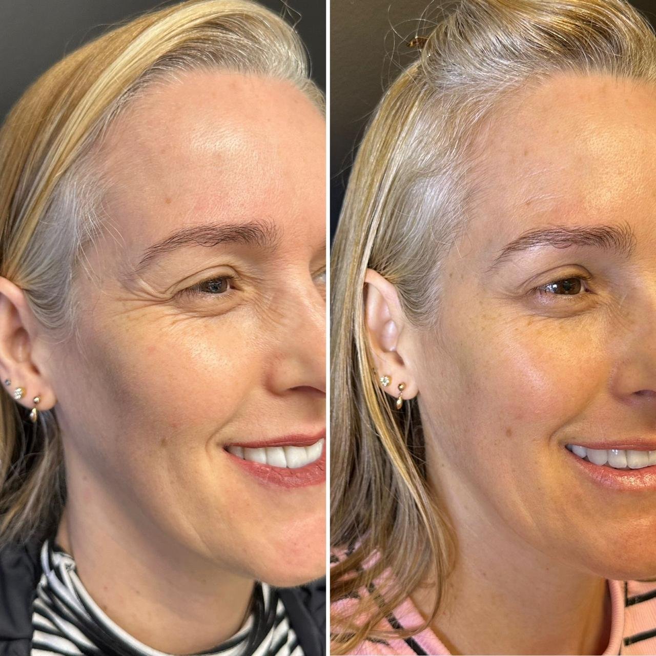 Resultado antes e depois